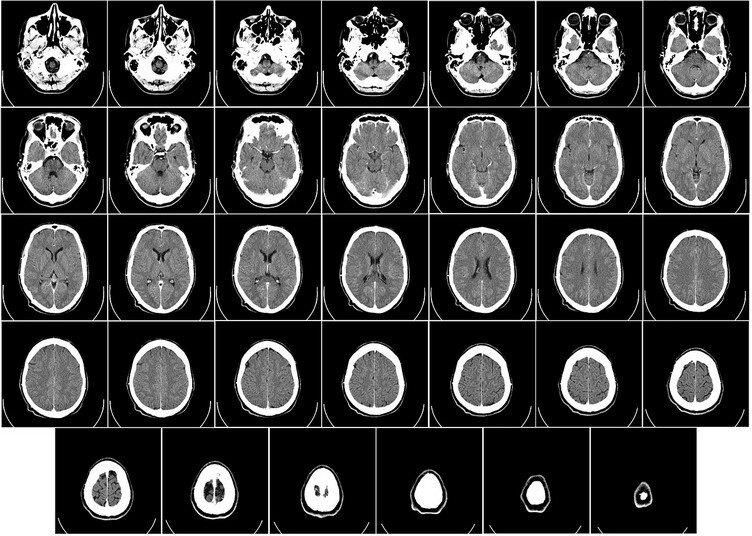 Tumores cerebrales aumentaran más con el 5G Tumores cerebrales aumentaran más con el 5G utilizando el telefono móvil